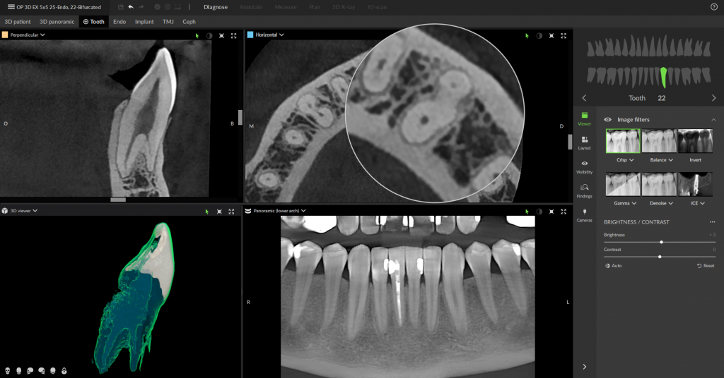 10_tooth_centric_22bifurcated.png 10_tooth_centric_22bifurcated.png